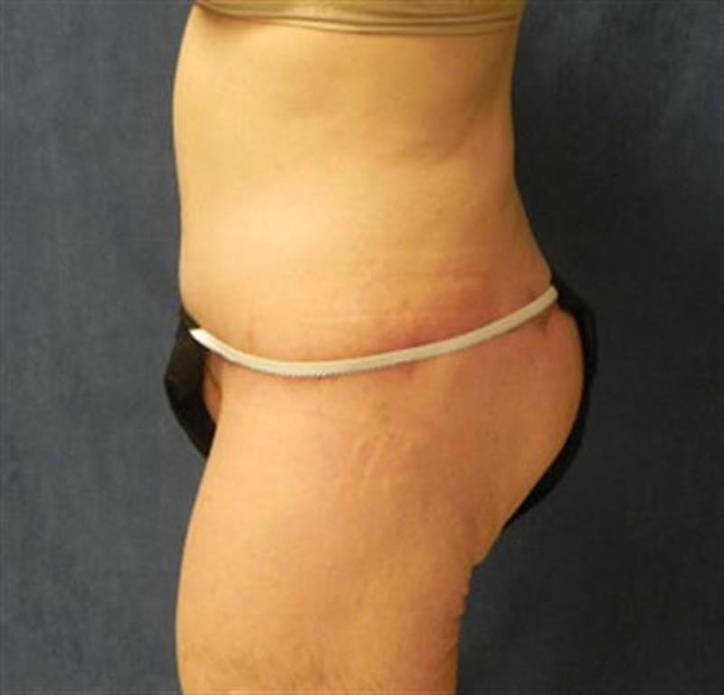 Body Lift Before & After Gallery - Patient 224361 - Image 4