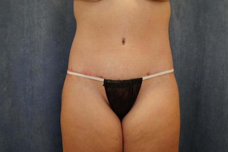 Body Lift Before & After Gallery - Patient 392712 - Image 2