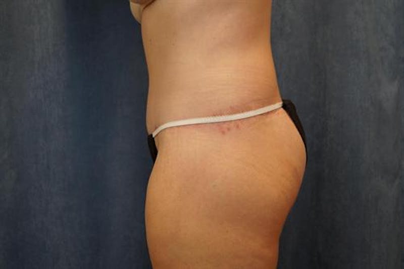 Body Lift Before & After Gallery - Patient 392712 - Image 4