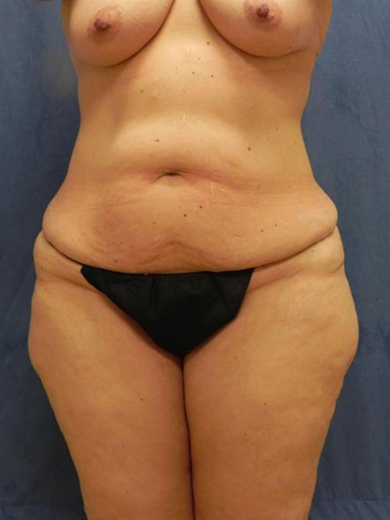 Body Lift Before & After Gallery - Patient 291640 - Image 1