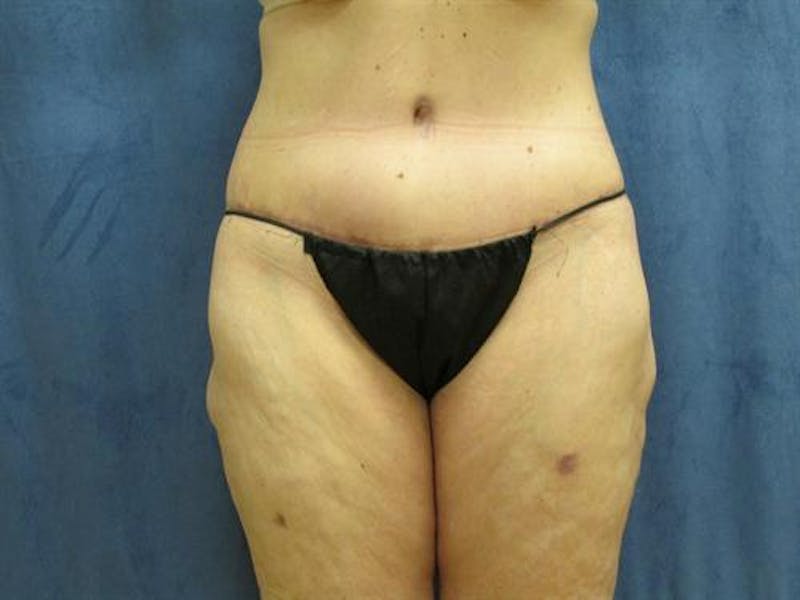 Body Lift Before & After Gallery - Patient 291640 - Image 2