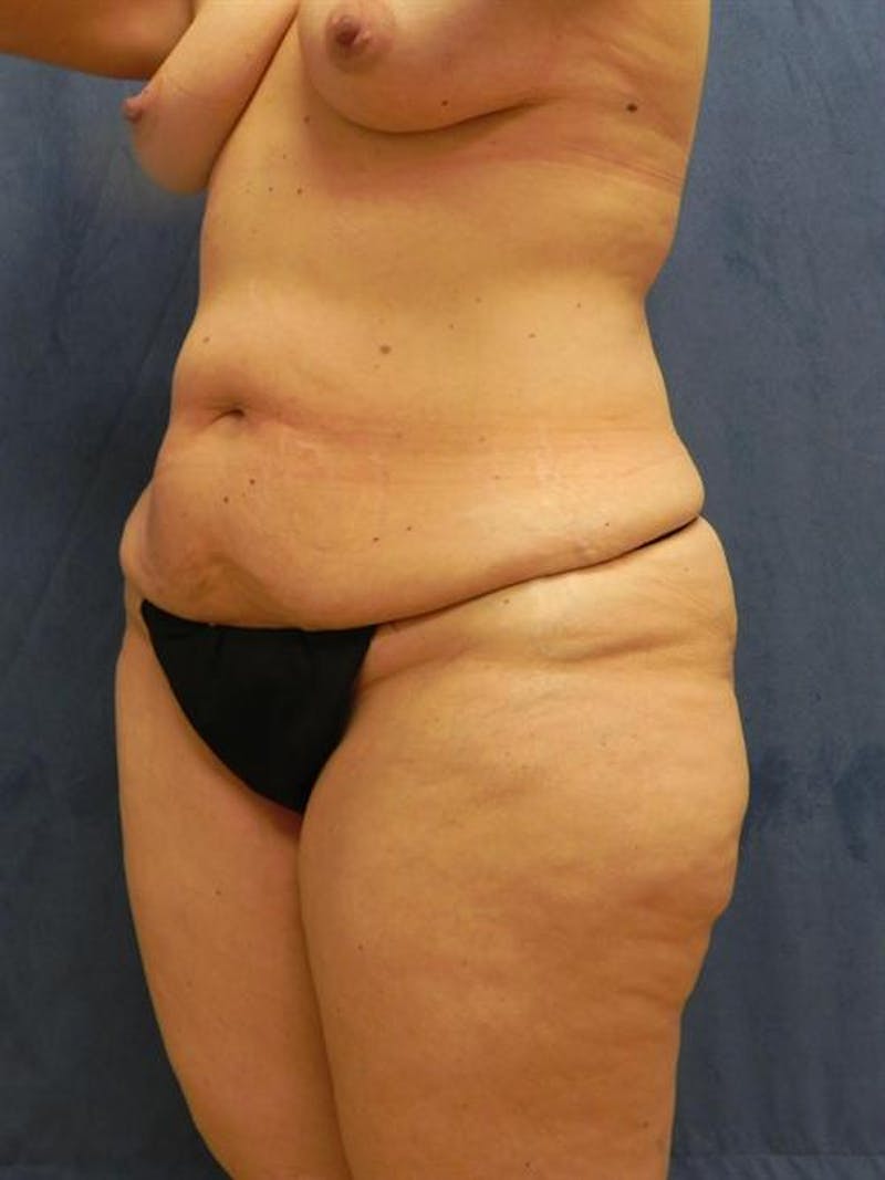 Body Lift Before & After Gallery - Patient 291640 - Image 3