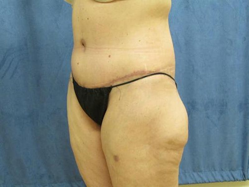 Body Lift Before & After Gallery - Patient 291640 - Image 4