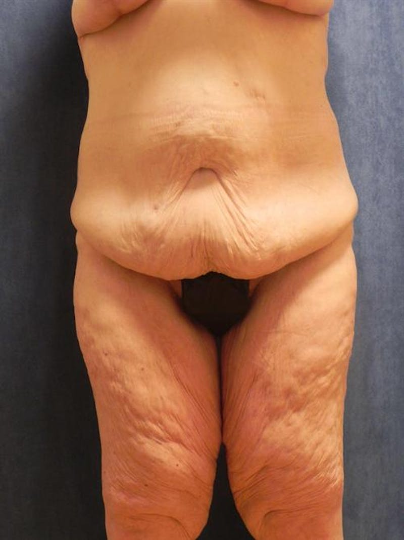 Body Lift Before & After Gallery - Patient 244979 - Image 1
