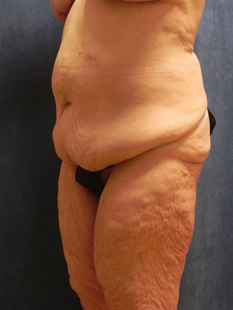 Body Lift Before & After Gallery - Patient 244979 - Image 3