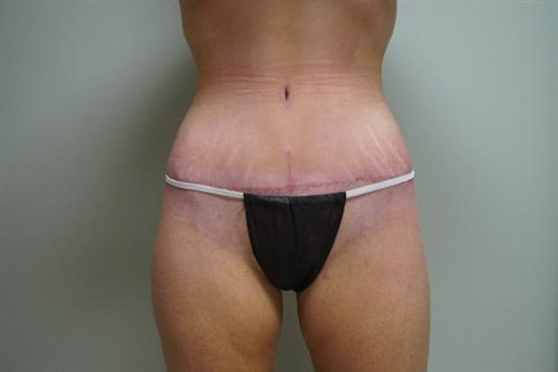 Body Lift Before & After Gallery - Patient 418442 - Image 2