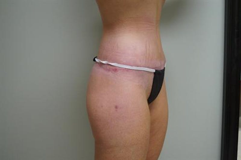 Body Lift Before & After Gallery - Patient 418442 - Image 4