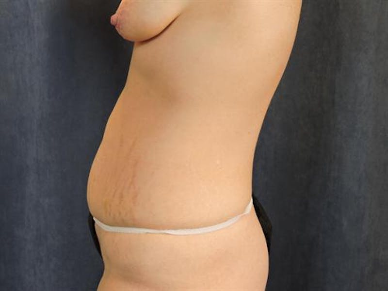 Body Lift Before & After Gallery - Patient 418442 - Image 5