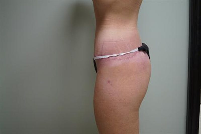 Body Lift Before & After Gallery - Patient 418442 - Image 6