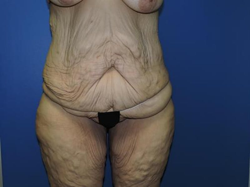 Body Lift Before & After Gallery - Patient 410292 - Image 1
