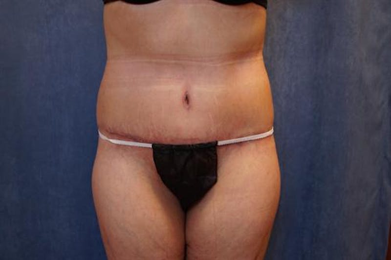 Body Lift Before & After Gallery - Patient 163832 - Image 2