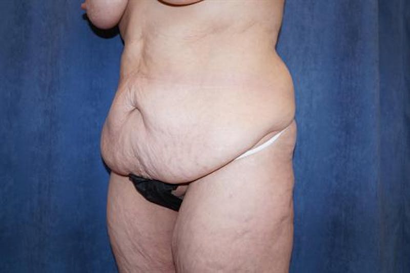 Body Lift Before & After Gallery - Patient 163832 - Image 3