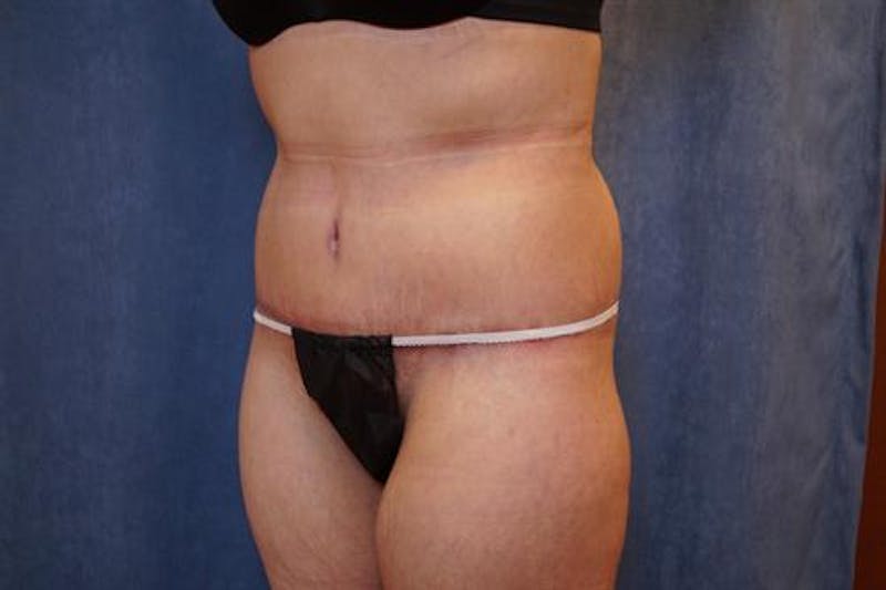 Body Lift Before & After Gallery - Patient 163832 - Image 4