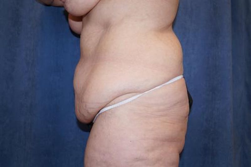 Body Lift Before & After Gallery - Patient 163832 - Image 5