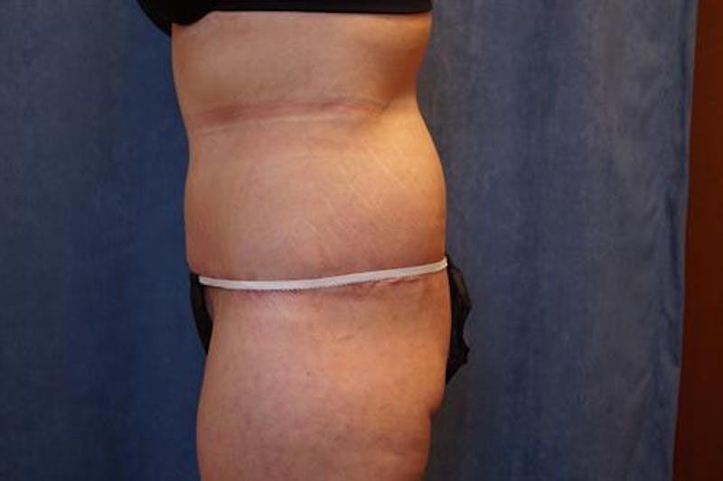 Body Lift Before & After Gallery - Patient 163832 - Image 6
