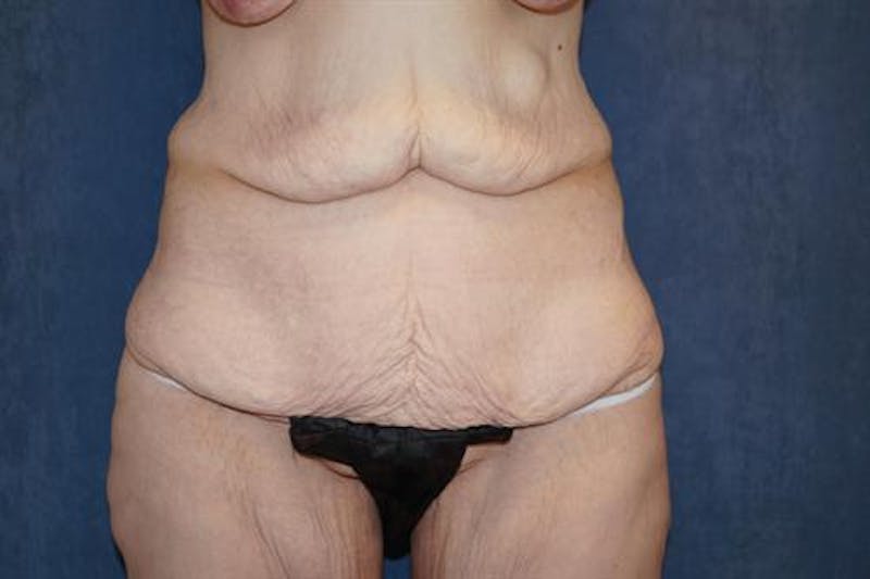 Body Lift Before & After Gallery - Patient 164096 - Image 1