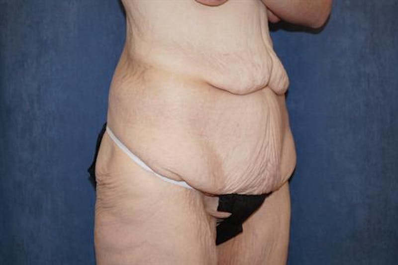 Body Lift Before & After Gallery - Patient 164096 - Image 3