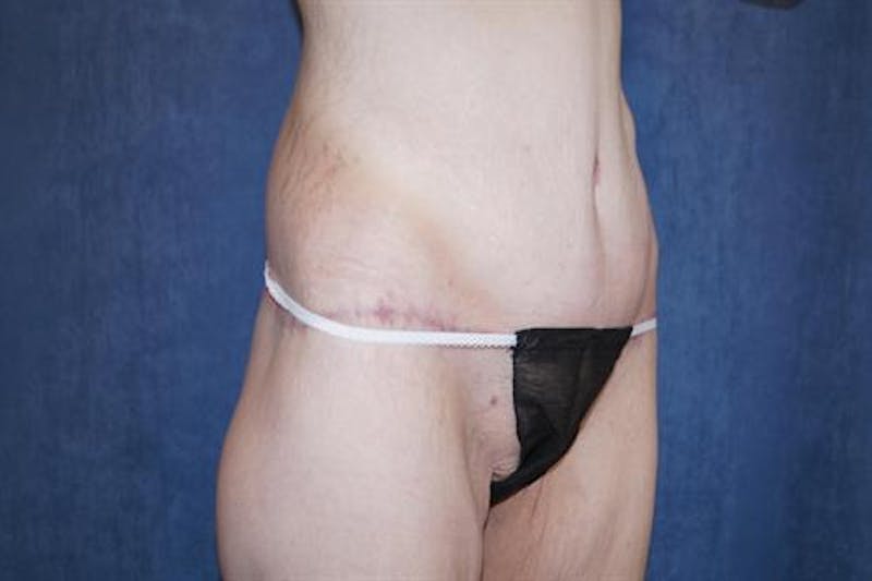Body Lift Before & After Gallery - Patient 164096 - Image 4