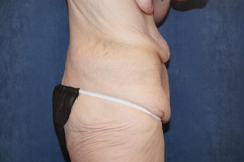 Body Lift Before & After Gallery - Patient 164096 - Image 5