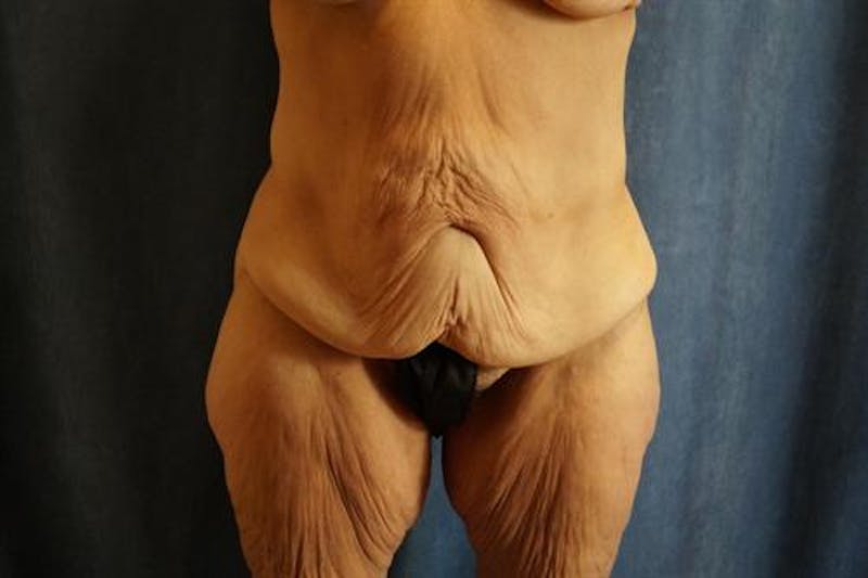 Body Lift Before & After Gallery - Patient 353055 - Image 1