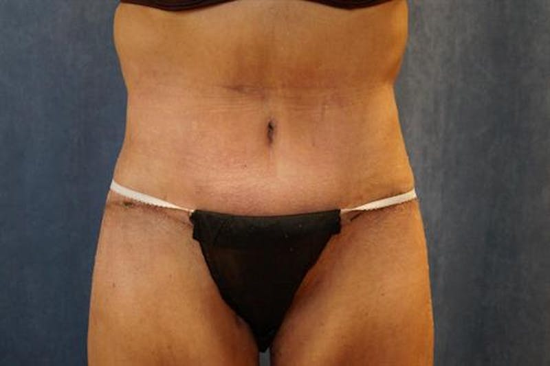 Body Lift Before & After Gallery - Patient 353055 - Image 2