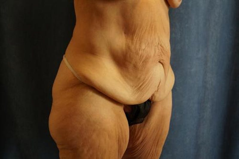 Body Lift Before & After Gallery - Patient 353055 - Image 3