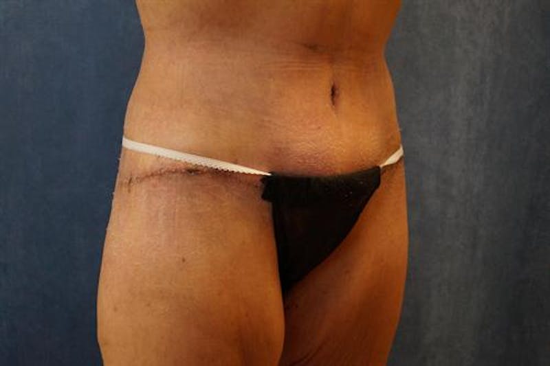 Body Lift Before & After Gallery - Patient 353055 - Image 4