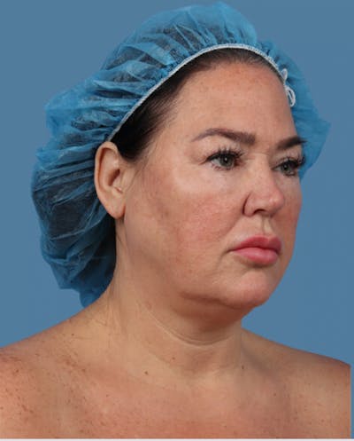 Facelift Before & After Gallery - Patient 254301 - Image 1