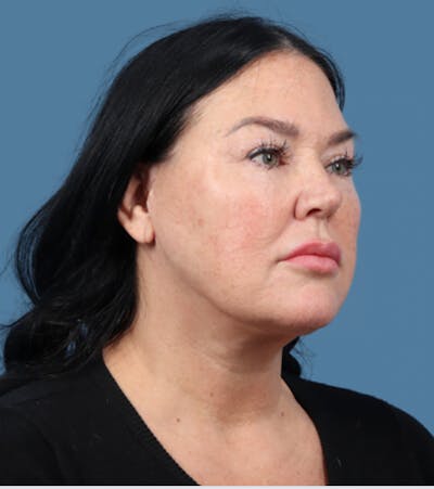 Facelift Before & After Gallery - Patient 254301 - Image 2