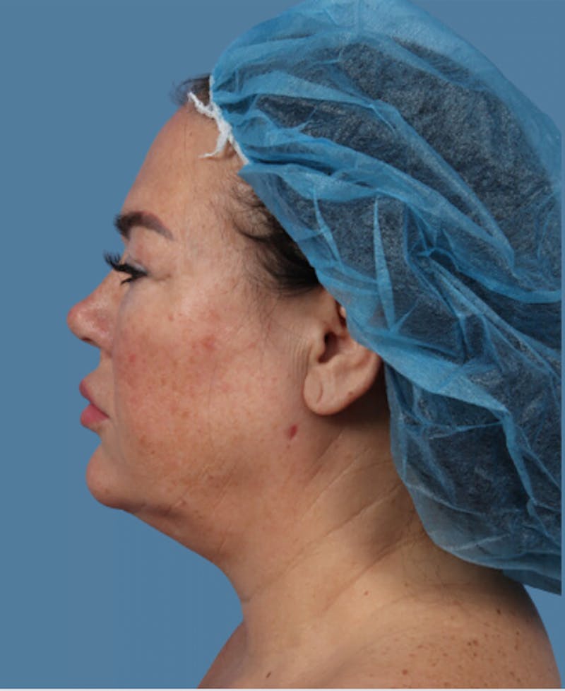 Facelift Before & After Gallery - Patient 254301 - Image 3