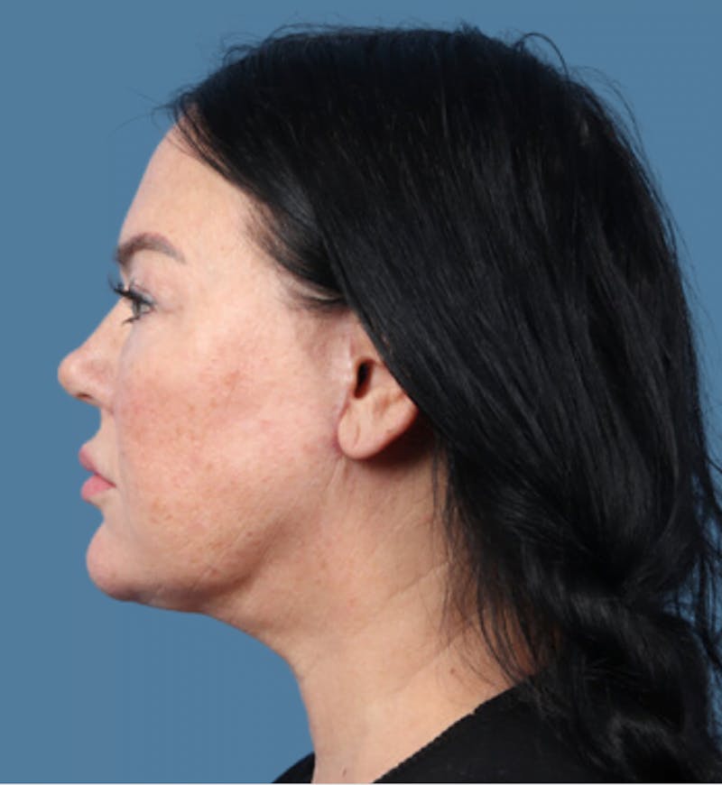 Facelift Before & After Gallery - Patient 254301 - Image 4