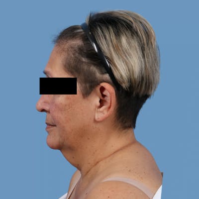 Facelift Before & After Gallery - Patient 957432 - Image 1