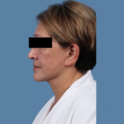 Facelift Before & After Gallery - Patient 957432 - Image 2