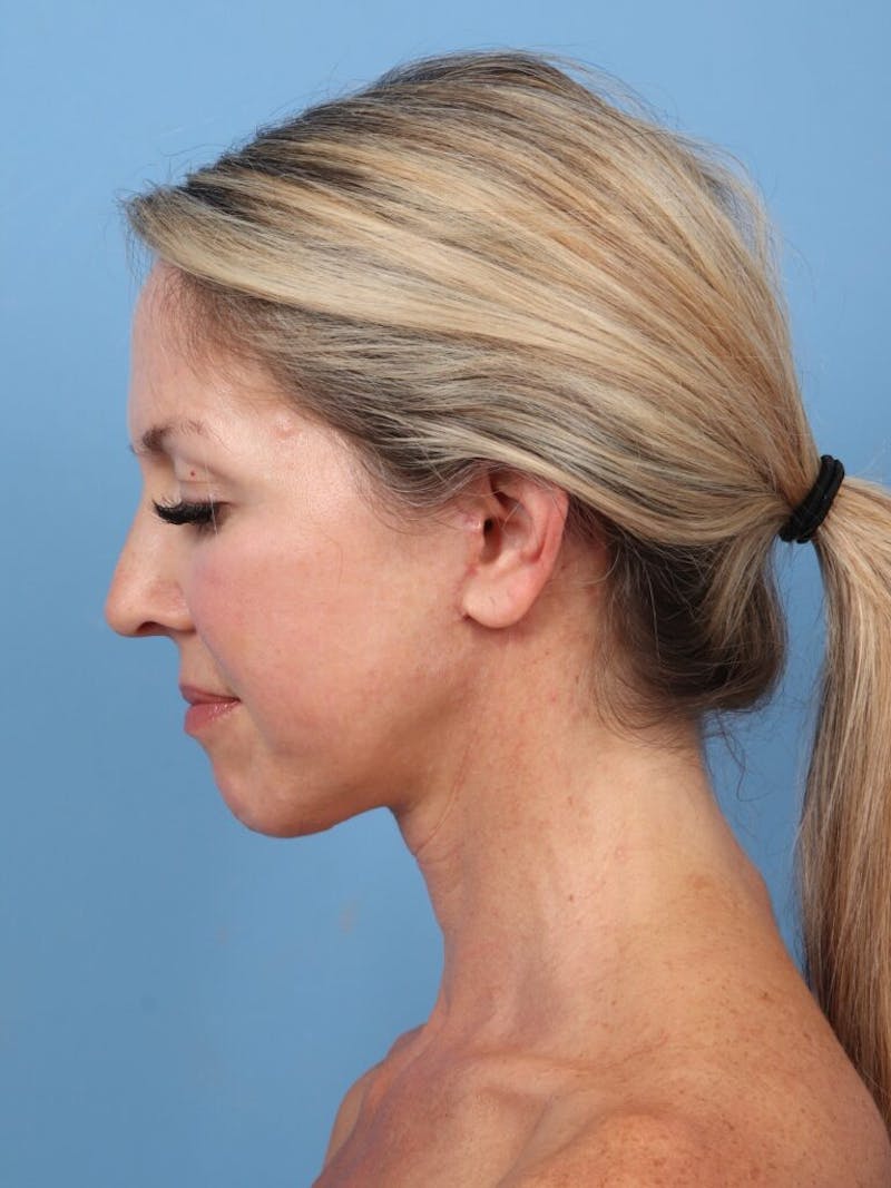 Facelift Before & After Gallery - Patient 237398 - Image 4