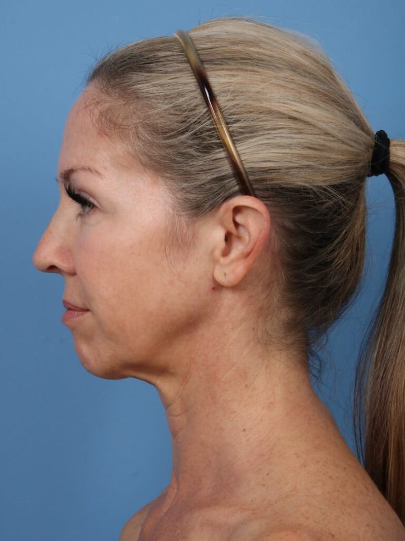 Facelift Before & After Gallery - Patient 237398 - Image 5
