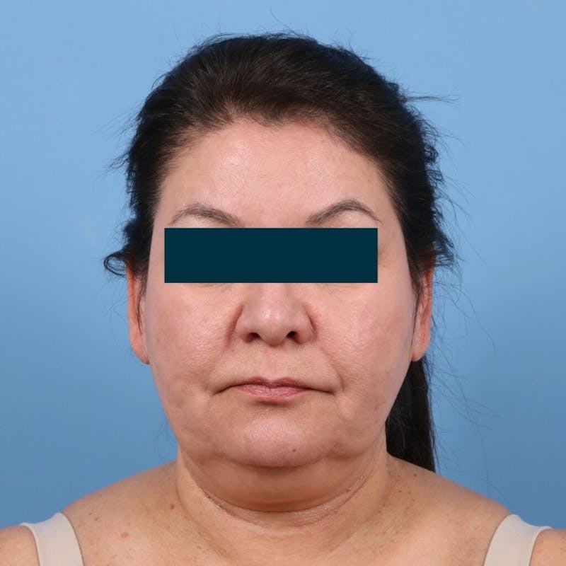 Facelift Before & After Gallery - Patient 270652 - Image 3