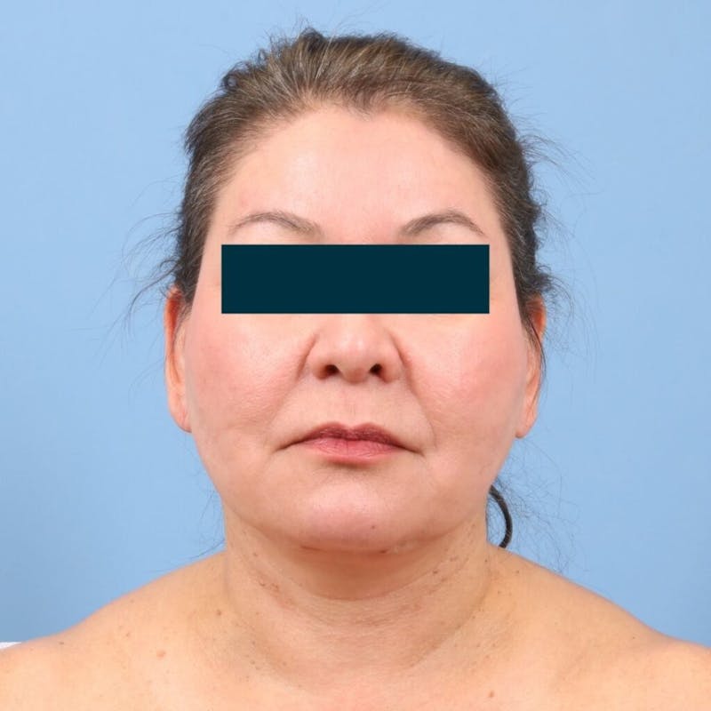 Facelift Before & After Gallery - Patient 270652 - Image 4