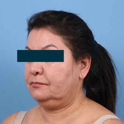 Facelift Before & After Gallery - Patient 270652 - Image 1