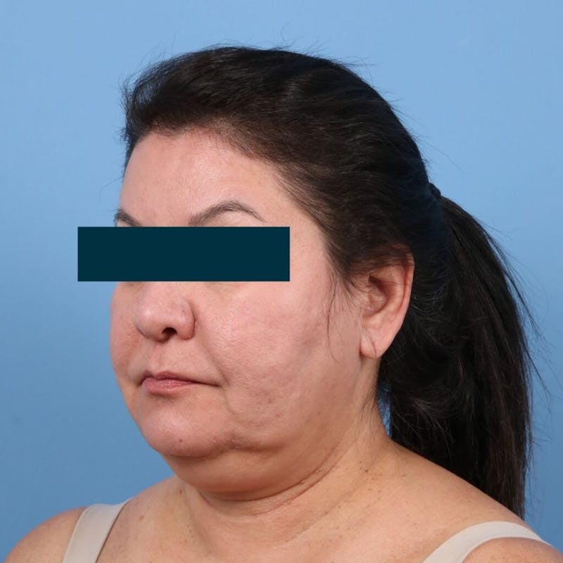 Facelift Before & After Gallery - Patient 270652 - Image 1
