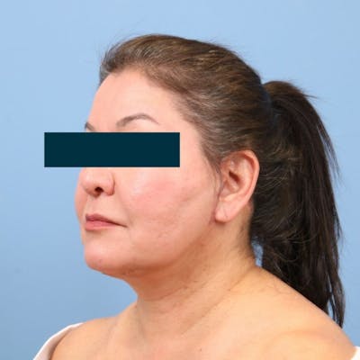 Facelift Before & After Gallery - Patient 270652 - Image 2