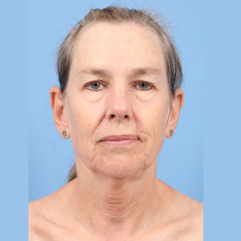 Facelift Before & After Gallery - Patient 301770 - Image 3