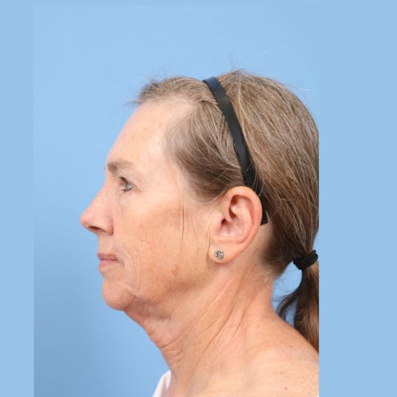Facelift Before & After Gallery - Patient 301770 - Image 5