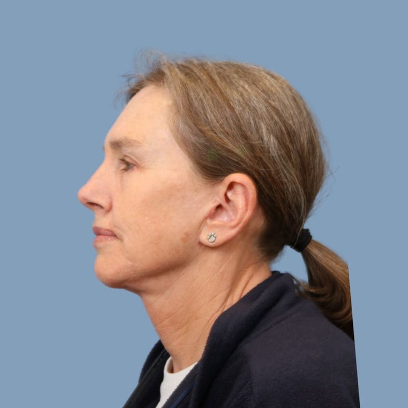 Facelift Before & After Gallery - Patient 301770 - Image 6