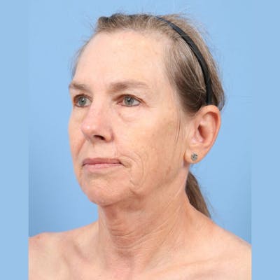 Facelift Before & After Gallery - Patient 301770 - Image 1