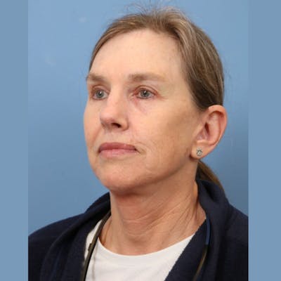 Facelift Before & After Gallery - Patient 301770 - Image 2