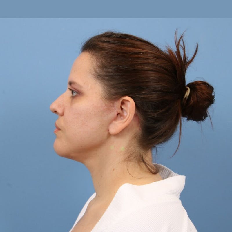 Facelift Before & After Gallery - Patient 392517 - Image 4