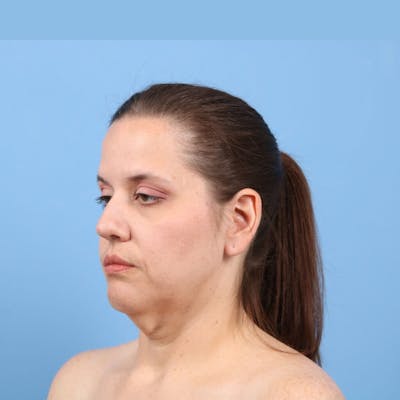 Facelift Before & After Gallery - Patient 392517 - Image 1