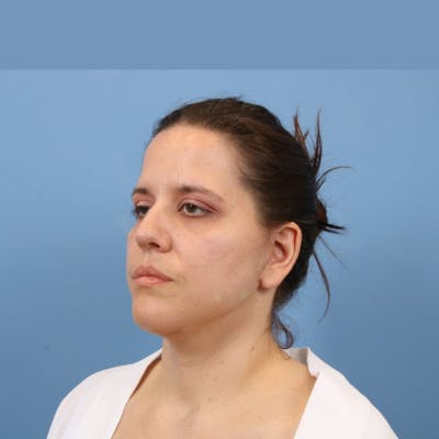 Facelift Before & After Gallery - Patient 392517 - Image 2