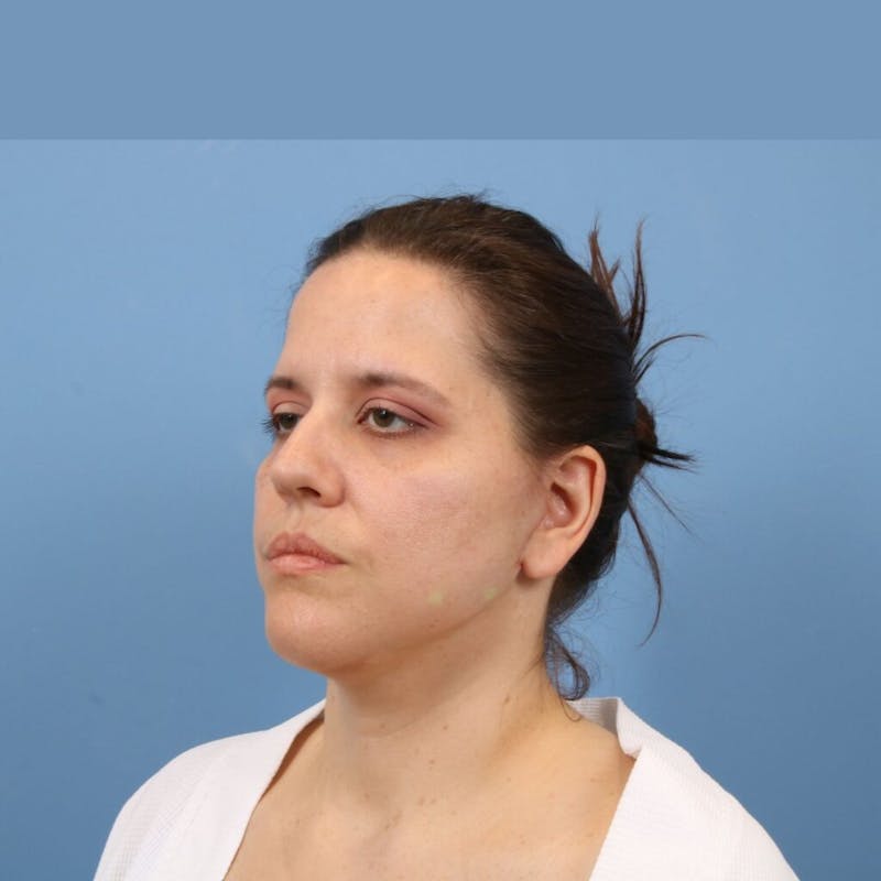 Facelift Before & After Gallery - Patient 392517 - Image 2