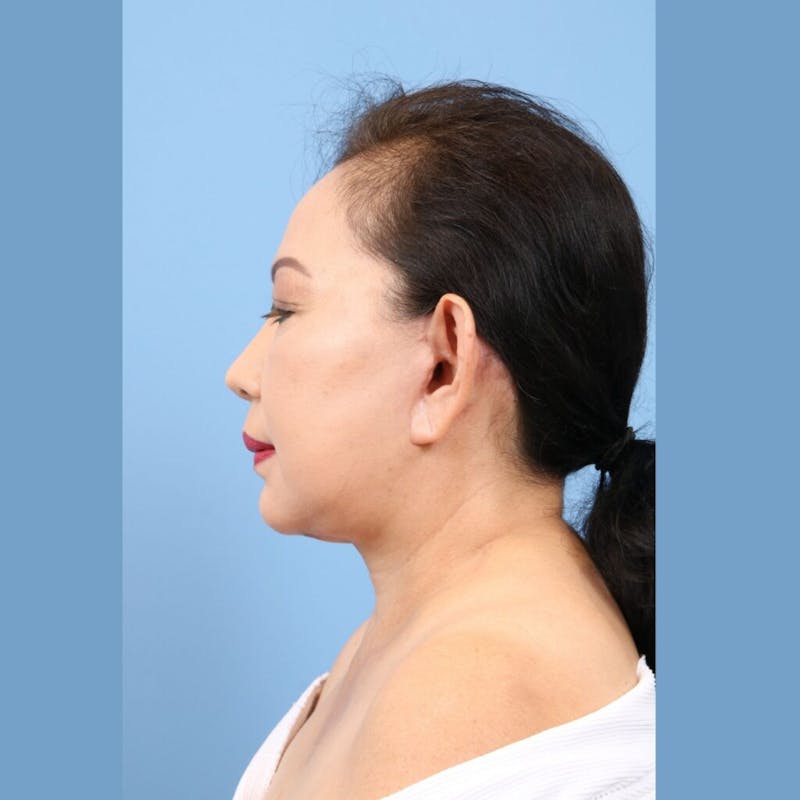 Facelift Before & After Gallery - Patient 143614 - Image 4